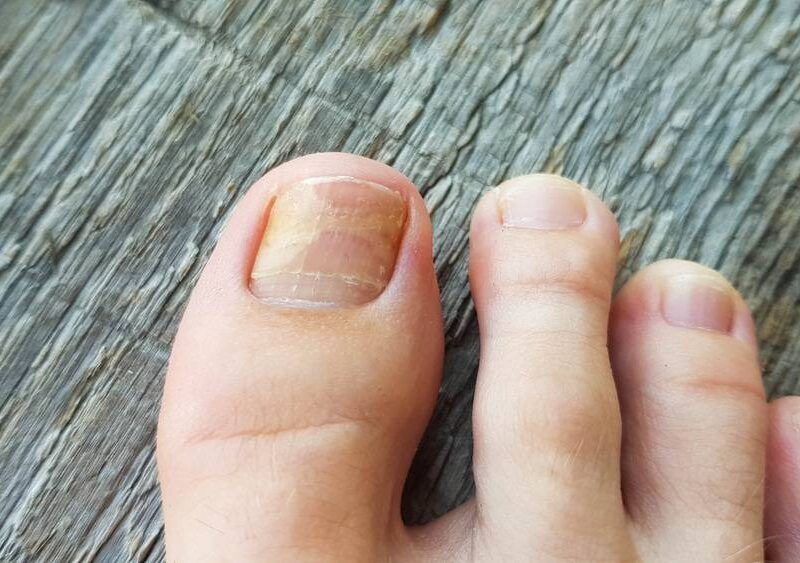 Onychomycosis- Treatment Options, Symptoms, And Diagnosis