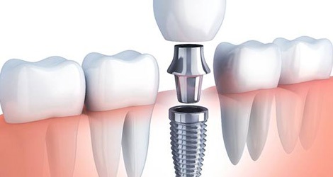 Exploring Dental Implants: Types And Benefits