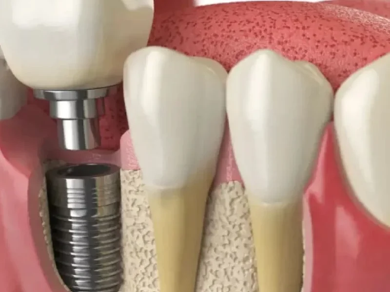 Understanding The Factors That Influence Dental Implant Costs