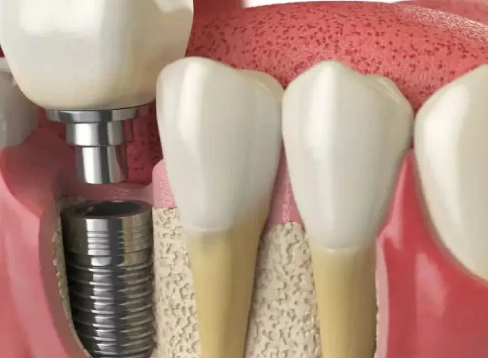 Understanding The Factors That Influence Dental Implant Costs
